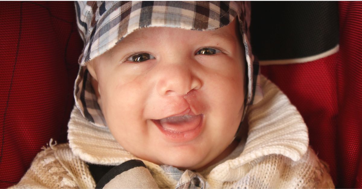 Cleft Lip and Cleft Palate