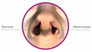 Normal-vs-Obstructed-768x432