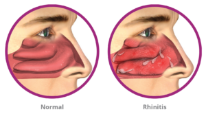 Normal-vs-Rhinitis
